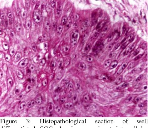 Figure 3 From Canine Squamous Cell Carcinoma A Review Of 17 Cases