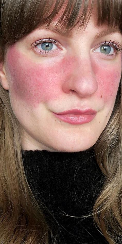 How To Hide Red Marks On Face Without Makeup Mugeek Vidalondon