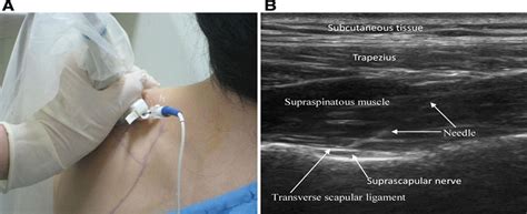 Ultrasound Guided Pulsed Radiofrequency Stimulation Of The S