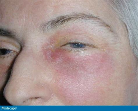 A 61 Year Old Woman With Swelling Of The Lower Eyelid