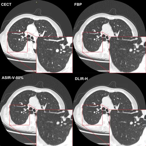 Deep Learning Reconstruction Shows Better Lung Nodule Detection For Ultralow Dose Chest Ct