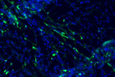 Immune Cells Play Crucial Role In Brain Cancer Development Newsroom