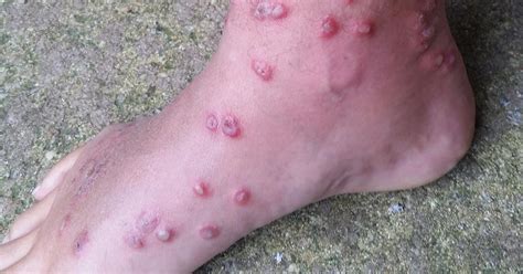 swimmer s itch parasite in delaware bay burrows in skin causes bumps