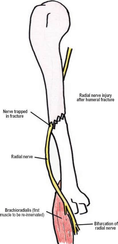 The Diagnostic Anatomy Of The Radial Nerve Neupsy Key