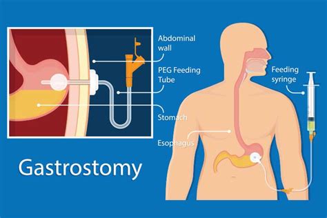 How To Insert Enteral Feeding Tube