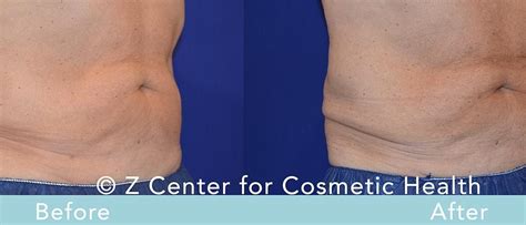Coolsculpting Flanks Before And After
