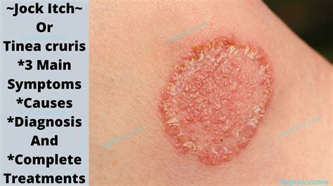 jock itch or tinea cruris 3 main symptoms causes diagnosis and complete treatments hopkin rx