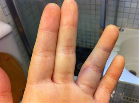 Home Remedies For Swollen Finger Finger Injury Jammed Finger Hand