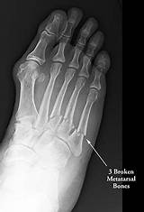 Broken Foot Bone On Side Photos