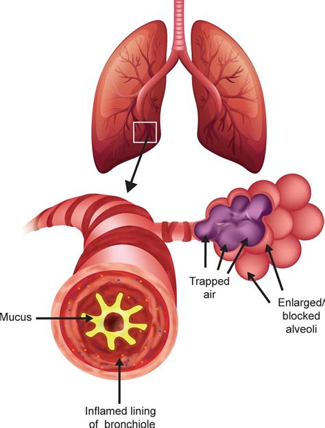 Pulmonary Pathophysiology