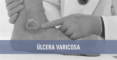 Ulcera Varicosa