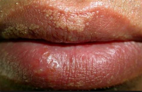 White Spots On Lips Images Galleries With A Bite