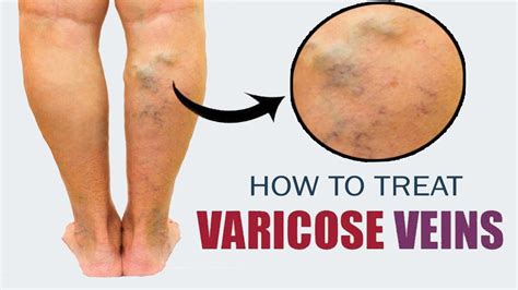 How To Treat Varicose Veins Naturally Home Remedies For Varicose