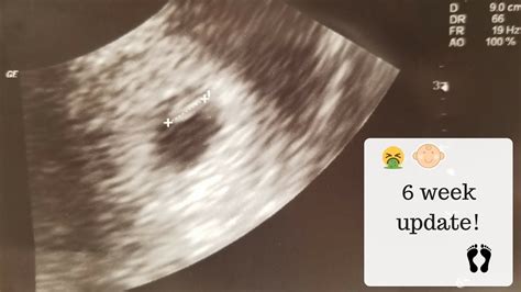 6 Week Pregnancy Update Issues Ultrasound Youtube