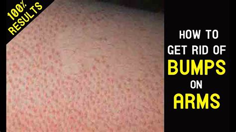 How To Get Rid Of Bumps On Armsface Chicken Skin And Hipstreatment
