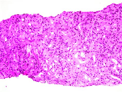 Adenocarcinoma Medical Pictures Info Health Definitions Photos