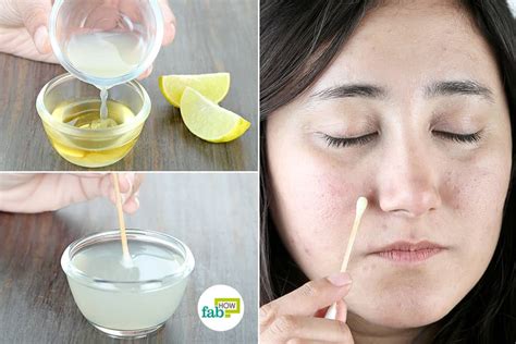 How To Remove Black Spots Fast In 3 Days From Pimples Overnight