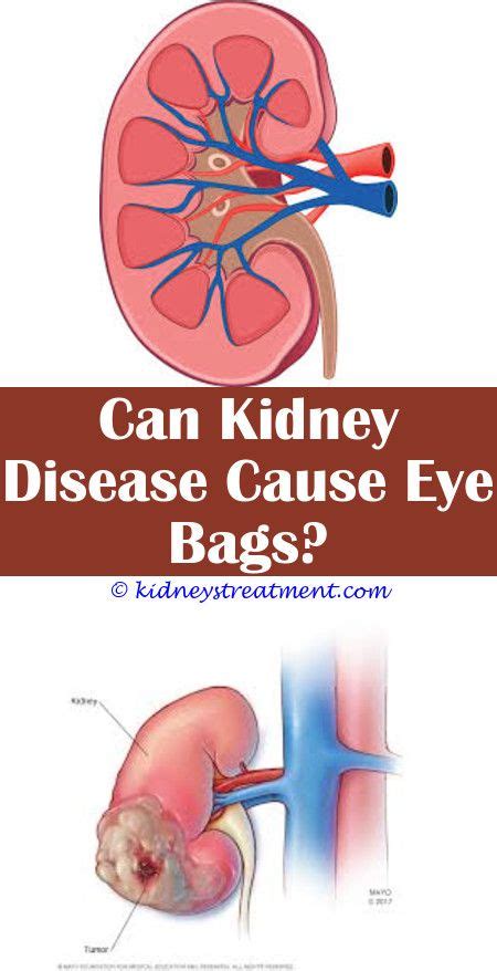 What Is Acute Kidney Injury Ppt Derifit