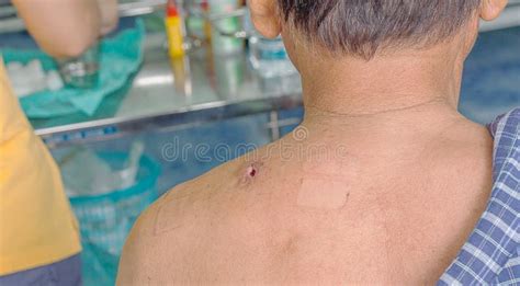 Abscess Wound Close Up Stock Photo Image Of Spot Treatment 126173882