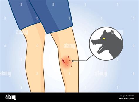 Dog Bite Wound Hi Res Stock Photography And Images Alamy