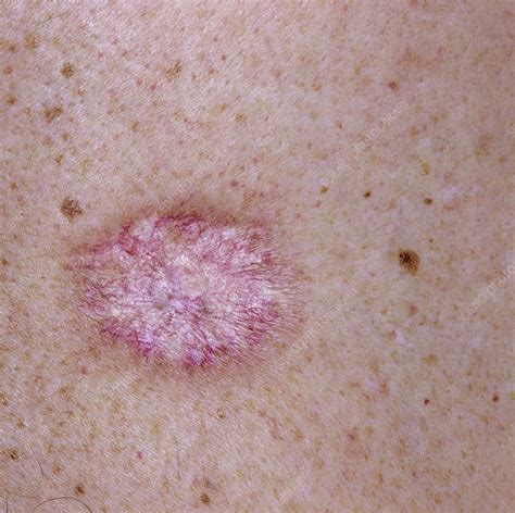 Skin Cancer Stock Image M1310604 Science Photo Library