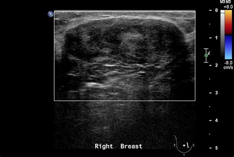 Fibroadenoma Of Breast Image