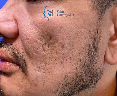 Looking For The Worlds Best Acne Acne Scar Doctor