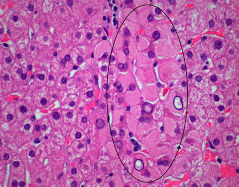 Pathology Pearls Post 5 Chronic Viral Hepatitis Aasld