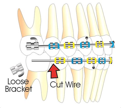 How To Cut Braces Wire At Home Emergency Care Goldreich