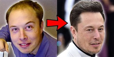 Elon Musk Hair Transplant How He Reversed His Hair Loss Techie Gamers