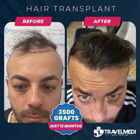 Hair Transplant In Turkey Travelmedi