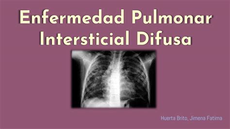 Enfermedad Pulmonar Intersticial Difusa Epid Radiolog A Udocz