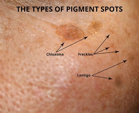 Hyperpigmentation Brown Spots What Are The Causes Electrolysis By Shelly