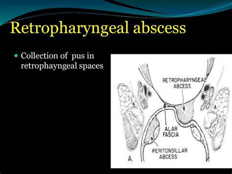 Surgical Treatment Of Paraphyrngeal And Retropharyngeal Abscesses