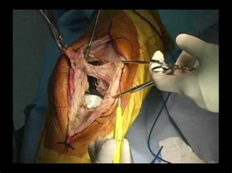 Serious problems are uncommon but risk cannot avoid kneeling until your wound has healed and you have an adequate bend. Incision and Exposure - Total Knee Revision - YouTube