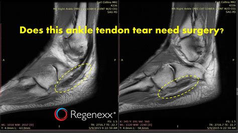 Foot Muscles Mri Mri Ankle Anatomy Foot Anatomy Ankle Anatomy Mri