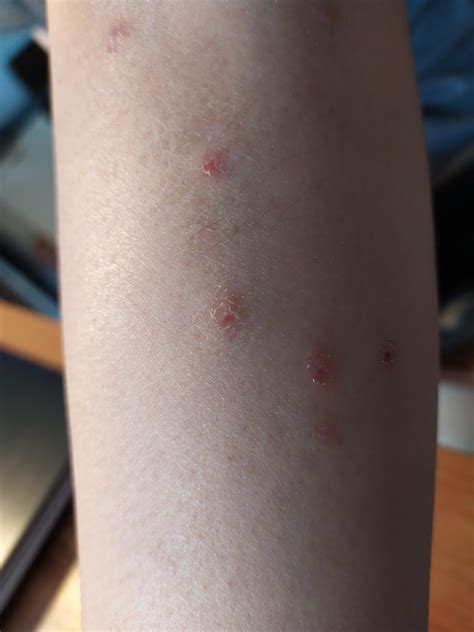 Skin Concern Red Bumps On My Arms And Legs Skincareaddiction