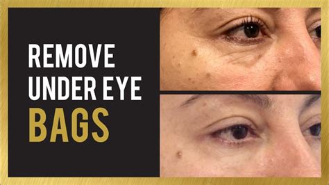 How To Remove Under Eye Bags Circles Filler Before And After Photos Youtube