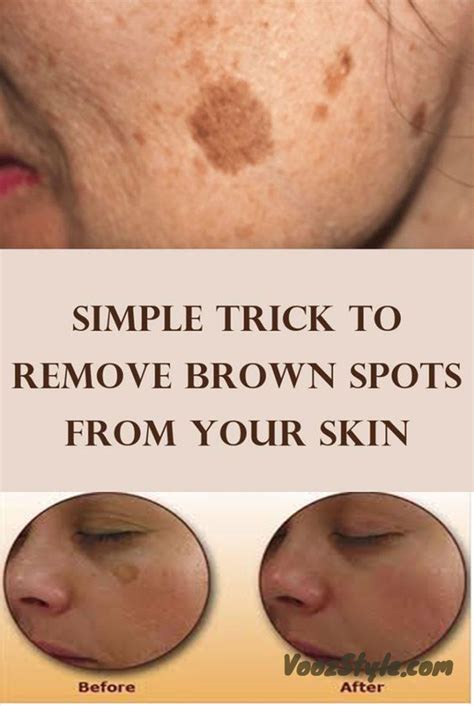 Simple Trick To Remove Brown Spots From Your Skin Spots On Face