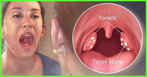 How To Get Rid Of Tonsils Home Remedies