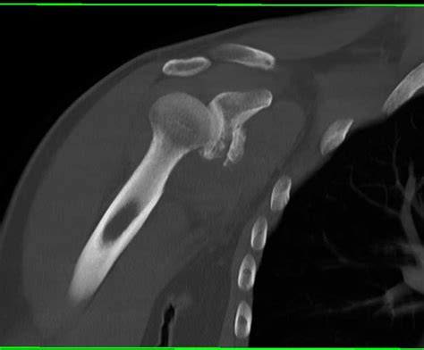 Shoulder Trauma with Glenoid Fracture - Trauma Case ...