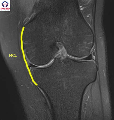 Medial Collateral Ligament Injuries Knee Sport Med School