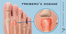 What is Freiberg’s Disease? - Podiatry HQ