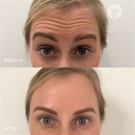 Anti Wrinkle Injections Brisbane Darwin Pricing And Gallery