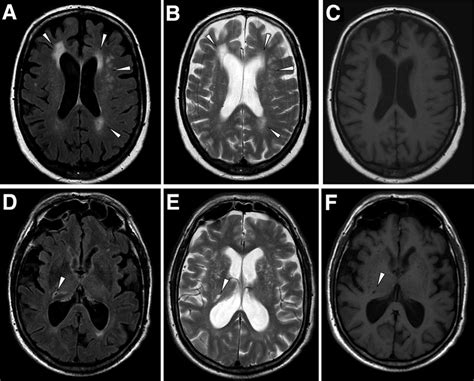 Magnetic Resonance Images Illustrating Wmls And Lacunar Infarcts In Two