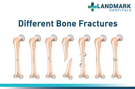 Types Of Fracture Fracture Bone Set Infographics Vect