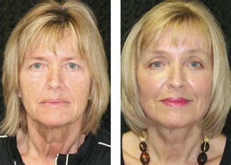 Facial Aerobics Exercises To Regenerate Your Throat And Face Natural