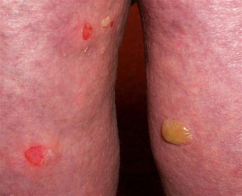 Derm Dx: Skin Blisters and Erosion in an Elderly Woman - Dermatology ...