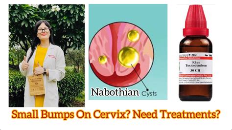 Nabothian Cyst Homeopathic Medicine Cervical Cyst Homeopathic Treatment Bumps On Cervix Dr
