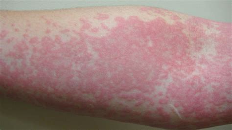 Urticaria Hives Causes Symptoms And Treatment
